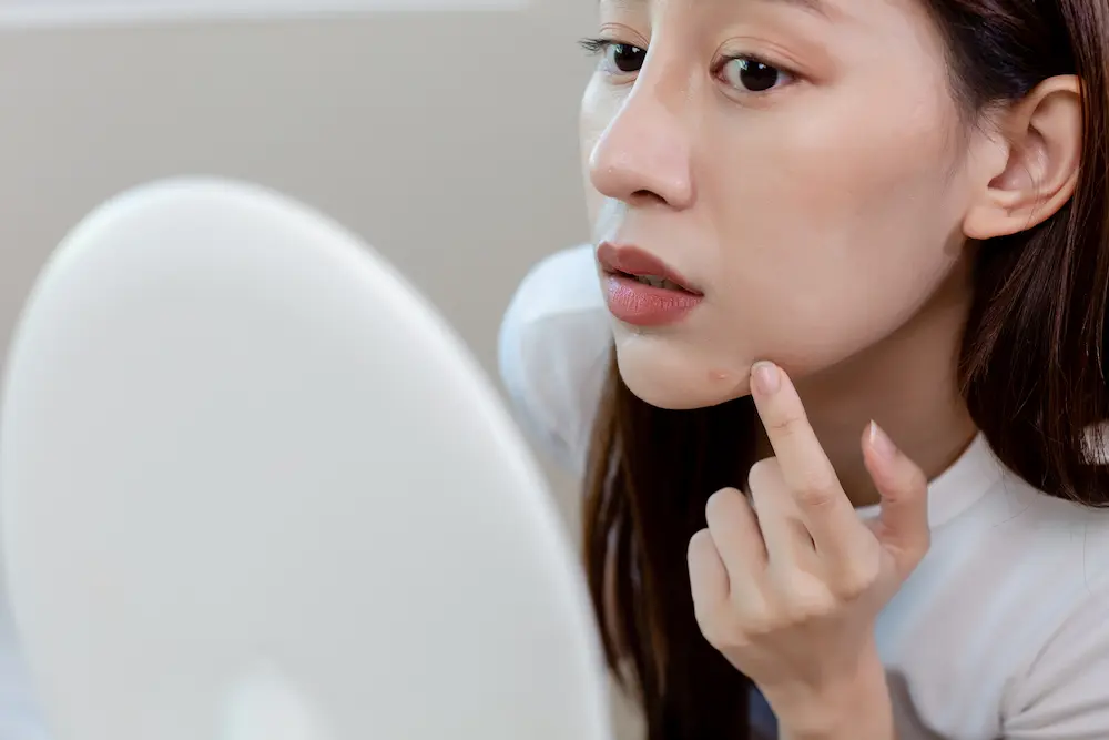 young woman squeezing acne with skin problems on the face, Retinol comes for the treatment of pimples on the skin.